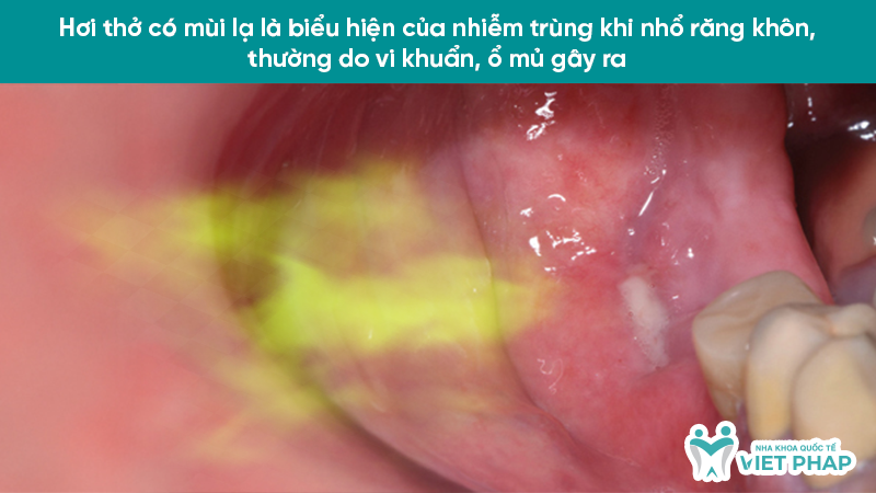 Hơi thở có mùi lạ là biểu hiện của nhiễm trùng khi nhổ răng khôn, thường do vi khuẩn, ổ mủ gây ra