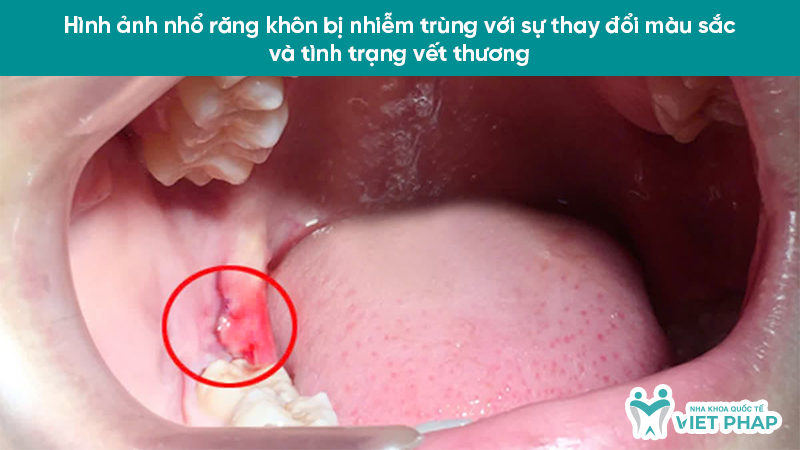 Hình ảnh nhổ răng khôn bị nhiễm trùng với sự thay đổi màu sắc và tình trạng vết thương
