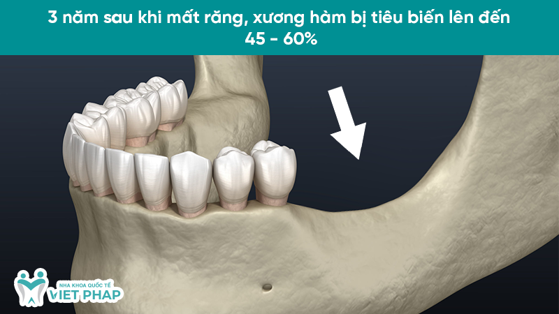 nho rang bao lau thi tieu xuong 1.2 3 năm sau khi mất răng, xương hàm bị tiêu biến lên đến 45 - 60%