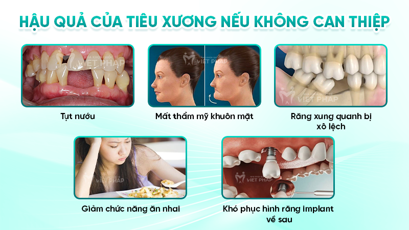 nho rang bao lau thi tieu xuong 3 Hậu quả của tiêu xương nếu không can thiệp