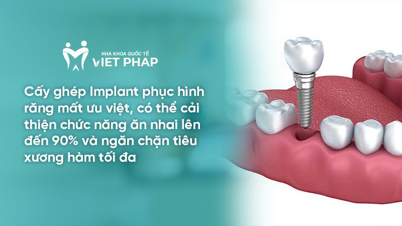 nho rang bao lau thi tieu xuong 4.1 Cấy ghép Implant phục hình răng mất ưu việt, có thể cải thiện chức năng ăn nhai lên đến 90% và ngăn chặn tiêu xương hàm tối đa