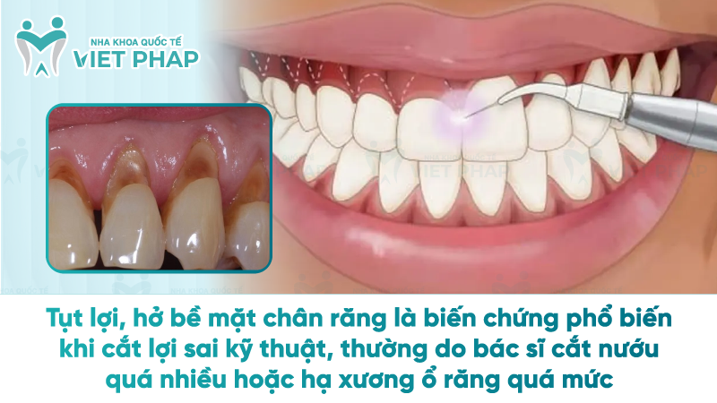 tac hai cua cat loi 1 Tụt lợi, hở bề mặt chân răng là biến chứng phổ biến khi cắt lợi sai kỹ thuật, thường do bác sĩ cắt nướu quá nhiều hoặc hạ xương ổ răng quá mức