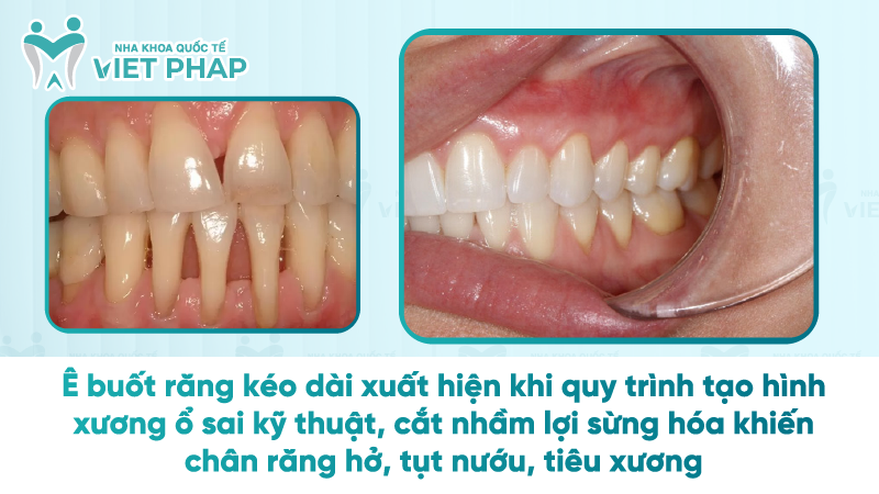 tac hai cua cat loi 2 Ê buốt răng kéo dài xuất hiện khi quy trình tạo hình xương ổ sai kỹ thuật, cắt nhầm lợi sừng hóa khiến chân răng hở, tụt nướu, tiêu xương