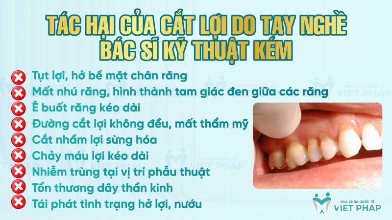 tac hai cua cat loi 3 Tác hại của cắt lợi do tay nghề bác sĩ kỹ thuật kém