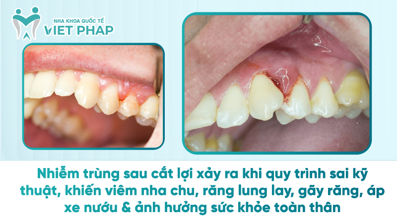 tac hai cua cat loi 4 Nhiễm trùng sau cắt lợi xảy ra khi quy trình sai kỹ thuật, khiến viêm nha chu, răng lung lay, gãy răng, áp xe nướu & ảnh hưởng sức khỏe toàn thân