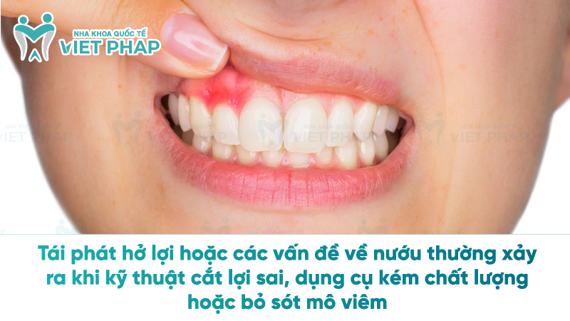 tac hai cua cat loi 5 Tái phát hở lợi hoặc các vấn đề về nướu thường xảy ra khi kỹ thuật cắt lợi sai, dụng cụ kém chất lượng hoặc bỏ sót mô viêm