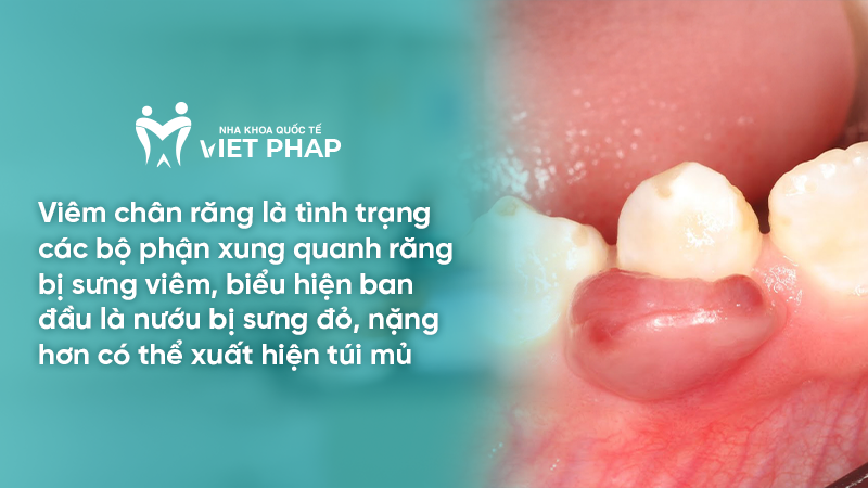 Viêm chân răng là tình trạng các bộ phận xung quanh răng bị sưng viêm, biểu hiện ban đầu là nướu bị sưng đỏ, nặng hơn có thể xuất hiện túi mủ