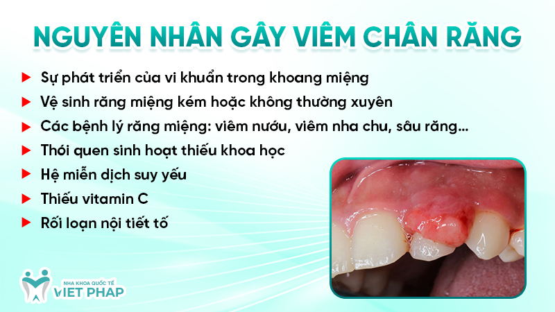 Nguyên nhân gây viêm chân răng
