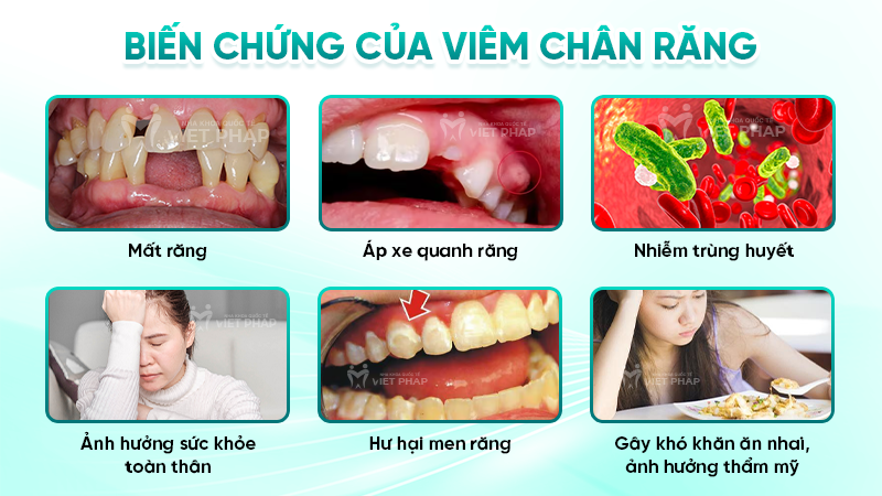 Biến chứng của viêm chân răng