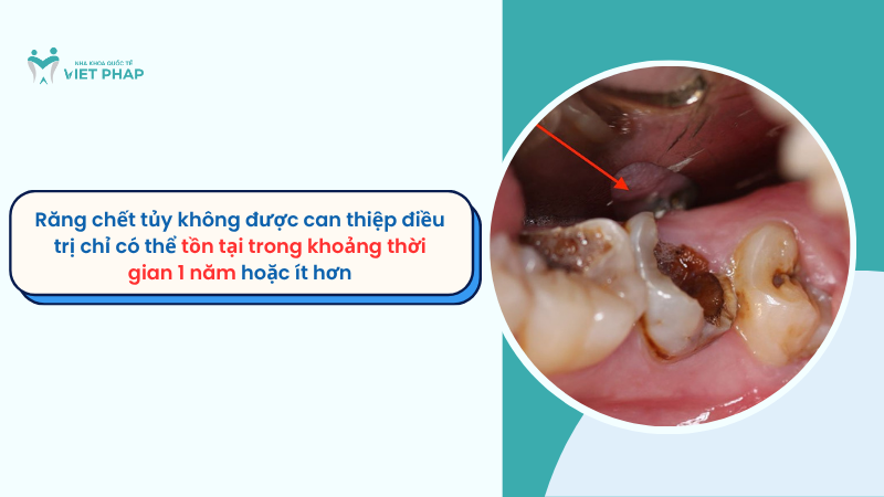 rang chet tuy ton tai duoc bao lau 2 Răng chết tủy không được can thiệp điều trị chỉ có thể tồn tại trong khoảng thời gian 1 năm hoặc ít hơn
