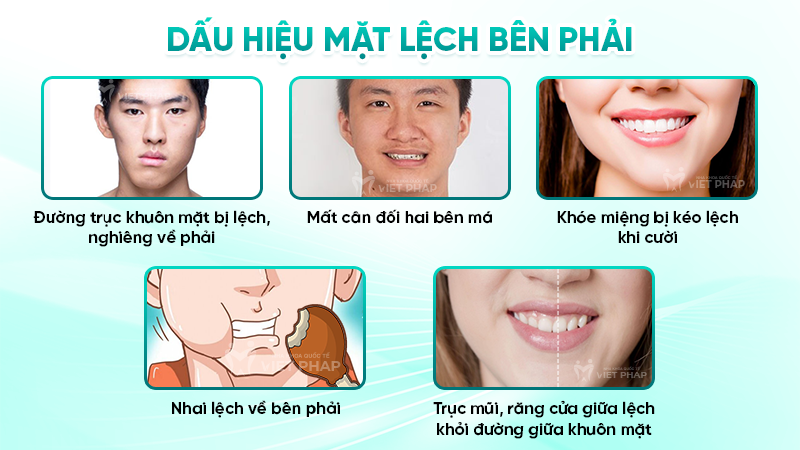 mat lech ben phai 1 Dấu hiệu mặt lệch bên phải