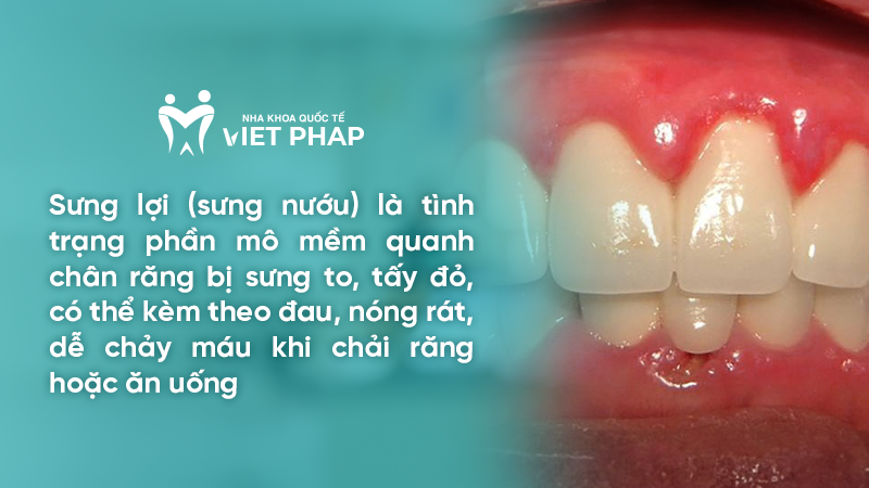 Sưng lợi (sưng nướu) là tình trạng phần mô mềm quanh chân răng bị sưng to, tấy đỏ, có thể kèm theo đau, nóng rát, dễ chảy máu khi chải răng hoặc ăn uống