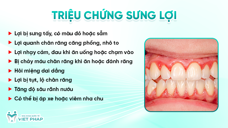 Triệu chứng sưng lợi 