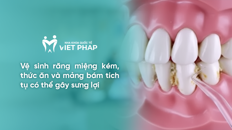 Vệ sinh răng miệng kém, thức ăn và mảng bám tích tụ có thể gây sưng lợi