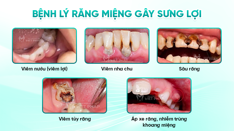 Bệnh lý răng miệng gây sưng lợi 