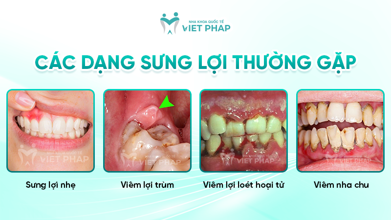 Các dạng sưng lợi thường gặp
