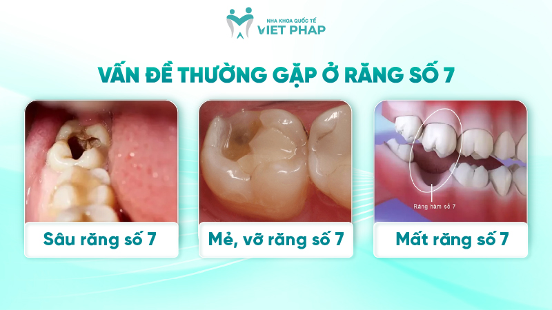 251203 rang so 7 o vi tri nao 04 Vấn đề thường gặp ở răng số 7