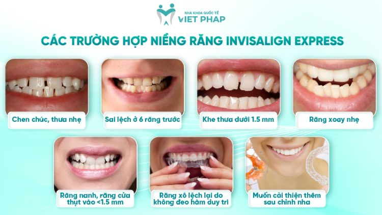 Ưu điểm niềng răng Invisalign Express - Số lượng khay, tính năng, chi phí