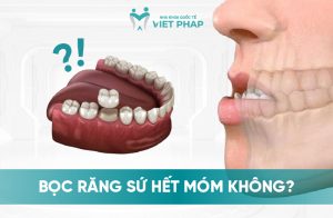 Tôi bị móm Bọc răng sứ hết không? Phương pháp điều trị hiệu và lưu ý cần biết