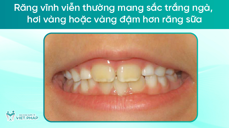251211 rang vinh vien 04 Răng vĩnh viễn thường mang sắc trắng ngà, hơi vàng hoặc vàng đậm hơn răng sữa
