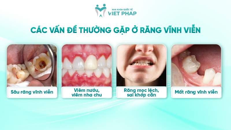 251211 rang vinh vien 07 Các vấn đề thường gặp ở răng vĩnh viễn