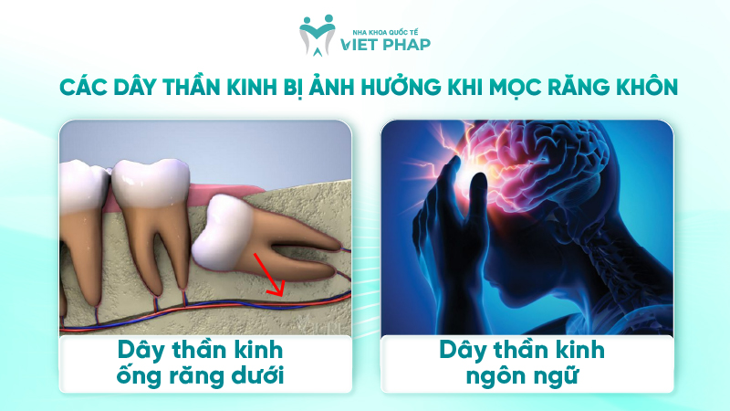 251212 Rang khon moc lech cham day than kinh 02 Các dây thần kinh bị ảnh hưởng khi mọc răng khôn