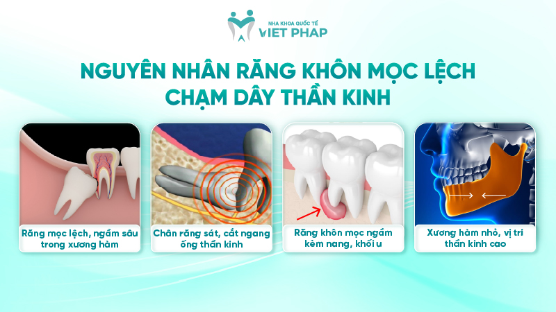 251212 Rang khon moc lech cham day than kinh 04 Nguyên nhân răng khôn mọc lệch chạm dây thần kinh