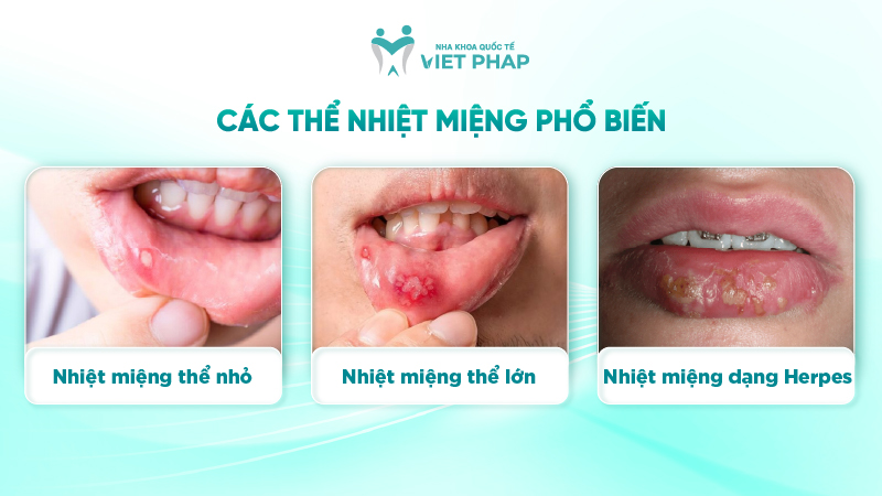251212 hinh anh nhiet mieng 03 Các thể nhiệt miệng phổ biến