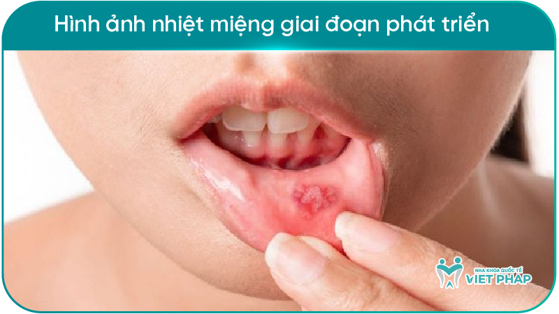 251212 hinh anh nhiet mieng 05 Hình ảnh nhiệt miệng giai đoạn phát triển