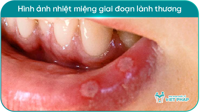 251212 hinh anh nhiet mieng 06 Hình ảnh nhiệt miệng giai đoạn lành thương