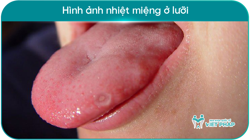 251212 hinh anh nhiet mieng 07 Hình ảnh nhiệt miệng ở lưỡi