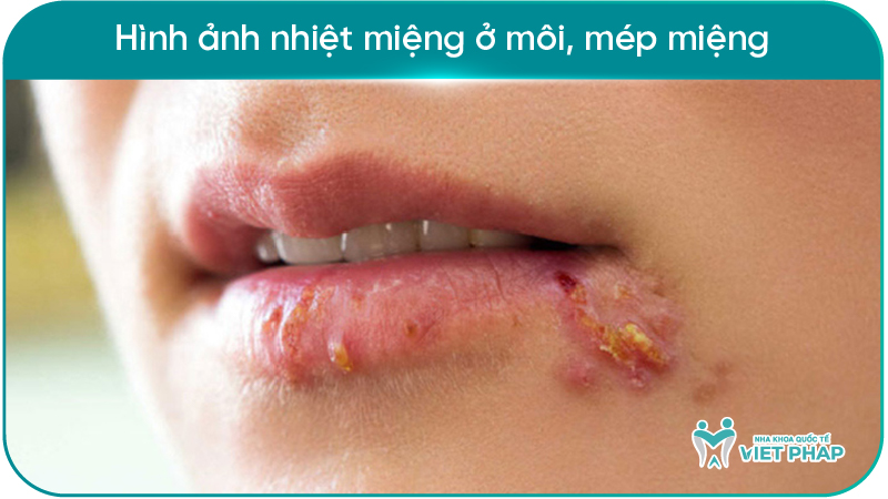 251212 hinh anh nhiet mieng 08 Hình ảnh nhiệt miệng ở môi, mép miệng