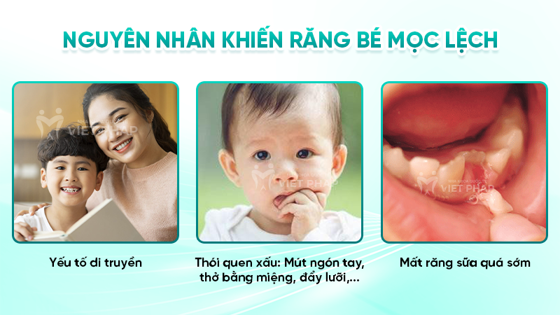 Nguyên nhân khiến răng bé mọc lệch