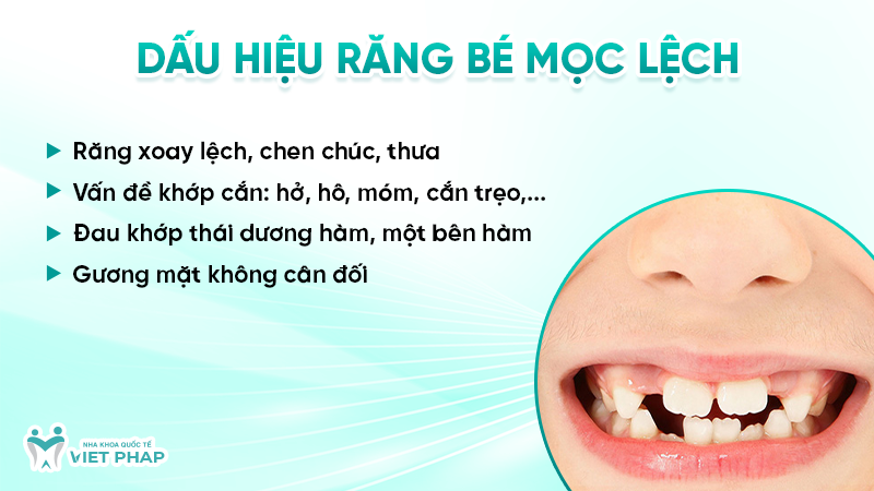 Dấu hiệu răng bé mọc lệch