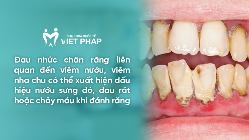 dau nhuc chan rang 3 Đau nhức chân răng liên quan đến viêm nướu, viêm nha chu có thể xuất hiện dấu hiệu nướu sưng đỏ, đau rát hoặc chảy máu khi đánh răng