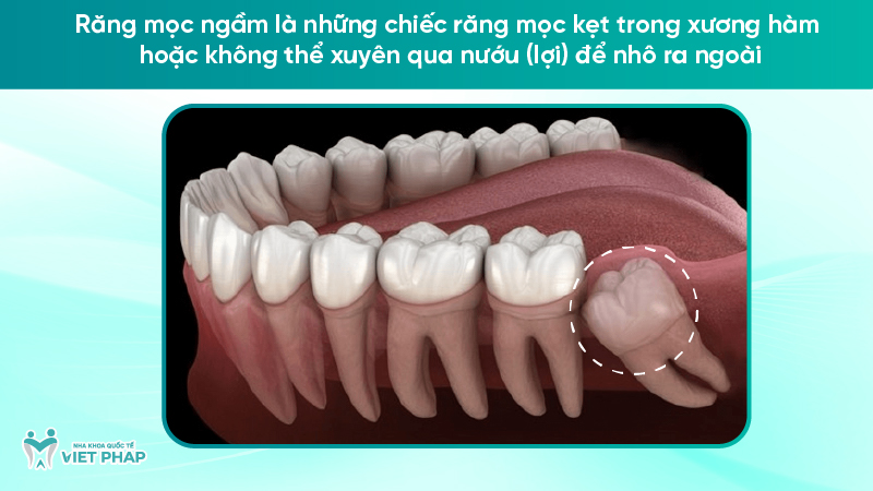 rang moc ngam 1 Răng mọc ngầm là những chiếc răng mọc kẹt trong xương hàm hoặc không thể xuyên qua nướu (lợi) để nhô ra ngoài
