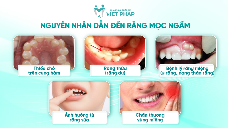 rang moc ngam 3 Nguyên nhân dẫn đến răng mọc ngầm