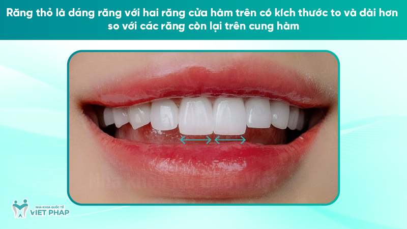 rang tho 1 Răng thỏ là dáng răng với hai răng cửa hàm trên có kích thước to và dài hơn so với các răng còn lại trên cung hàm