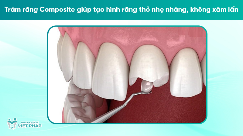 rang tho 4 Trám răng Composite giúp tạo hình răng thỏ nhẹ nhàng, không xâm lấn