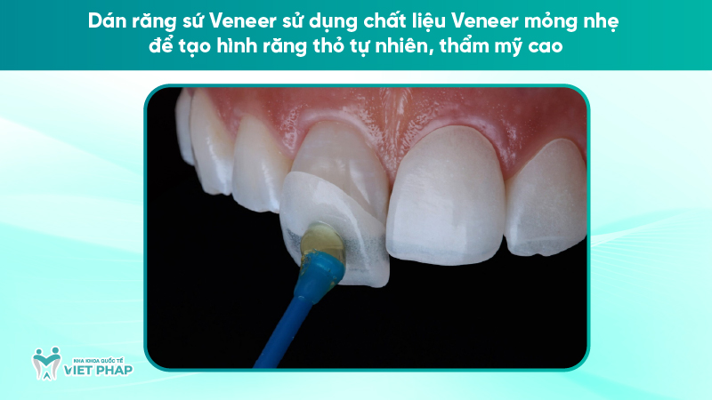 rang tho 5 Dán răng sứ Veneer sử dụng chất liệu Veneer mỏng nhẹ để tạo hình răng thỏ tự nhiên, thẩm mỹ ca