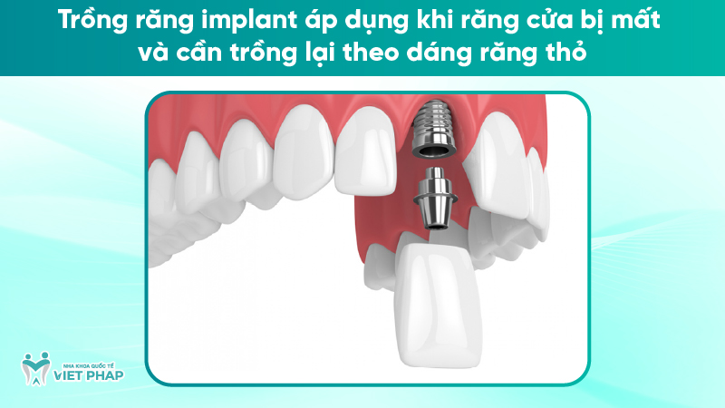 rang tho 7 Trồng răng implant áp dụng khi răng cửa bị mất và cần trồng lại theo dáng răng thỏ