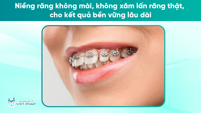 rang tho 8 Niềng răng không mài, không xâm lấn răng thật, cho kết quả bền vững lâu dài