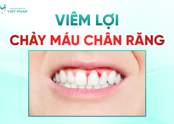 [Cảnh báo] Viêm lợi chảy máu chân răng rất nguy hiểm? Hậu quả và cách phòng ngừa tuyệt đối
