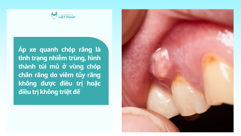 ap xe quanh chop rang 1 Áp xe quanh chóp răng là tình trạng nhiễm trùng, hình thành túi mủ ở vùng chóp chân răng do viêm tủy răng không được điều trị hoặc điều trị không triệt để