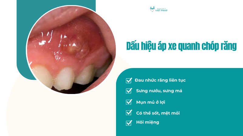 ap xe quanh chop rang 2 Dấu hiệu áp xe quanh chóp răng