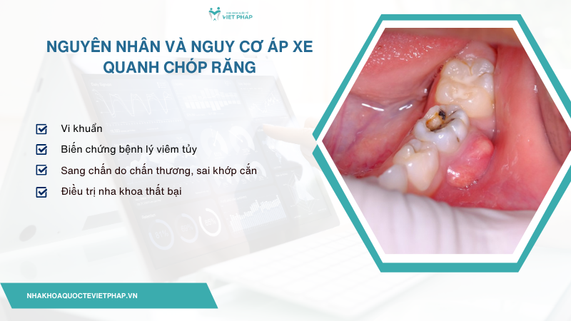 ap xe quanh chop rang 3 Nguyên nhân và nguy cơ áp xe quanh chóp răng