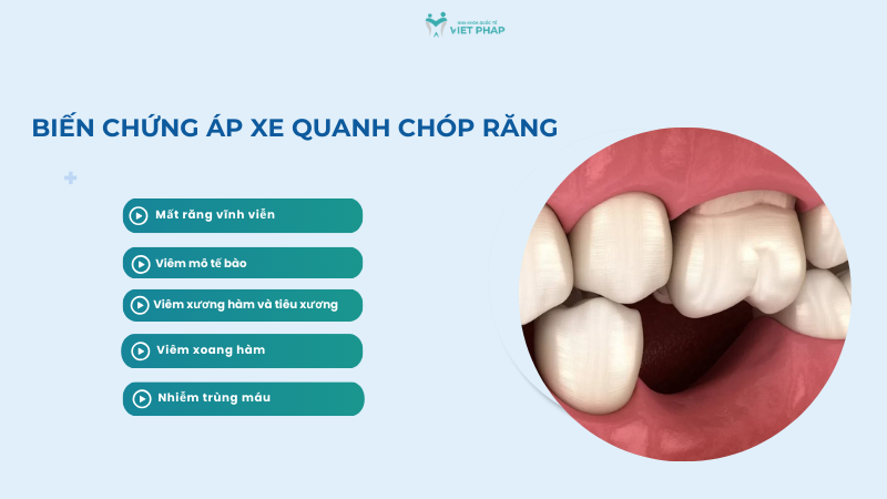 ap xe quanh chop rang 6 Biến chứng áp xe quanh chóp răng