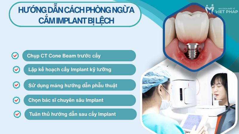 cam implant bi lech nha khoa quoc te viet phap 1 Cách khắc phục, xử lý trụ Implant bị lệch với các trường hợp nặng