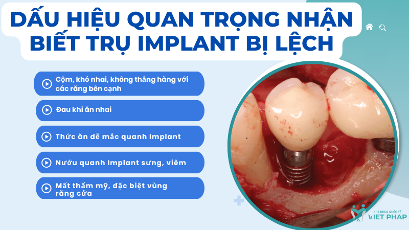 cam implant bi lech nha khoa quoc te viet phap 6 Dấu hiệu quan trọng nhận biết trụ Implant bị lệch
