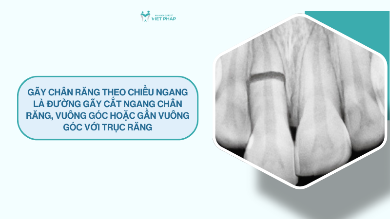Gãy chân răng theo chiều ngang là đường gãy cắt ngang chân răng, vuông góc hoặc gần vuông góc với trục răng
